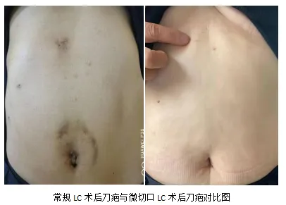 超微创胆囊手术让刀疤“神秘”消失